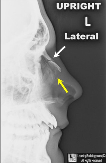 nasal bone fracture